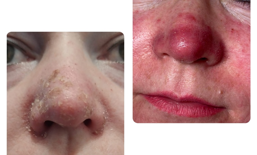 Image 2: CLEANESS ® Behandlungszentrum für Rosazea, Coupérose & Pigmentflecken