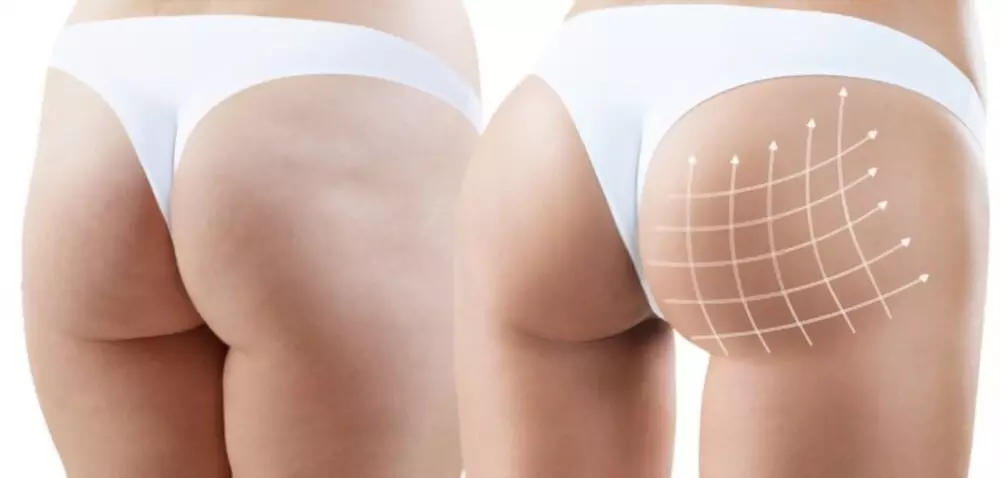 Up to 67% Off on Non-Surgical Butt Lift at Optimist Beauty Spa