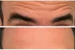 Transform Your Look with 30 or 60 Units of Dysport at Youthful Glow ( Up to 51% Off ) - Second Medium