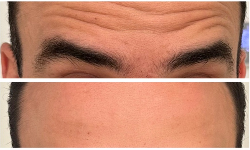 Image 7: Revitalize with 30 or 60 Units of Dysport at Youthful Glow