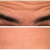 Image 7: Revitalize with 30 or 60 Units of Dysport at Youthful Glow