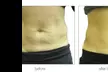 Up to 54% Off on Radio Frequency Skin Tightening at Beauty Factory Boutique Spa - Second Medium