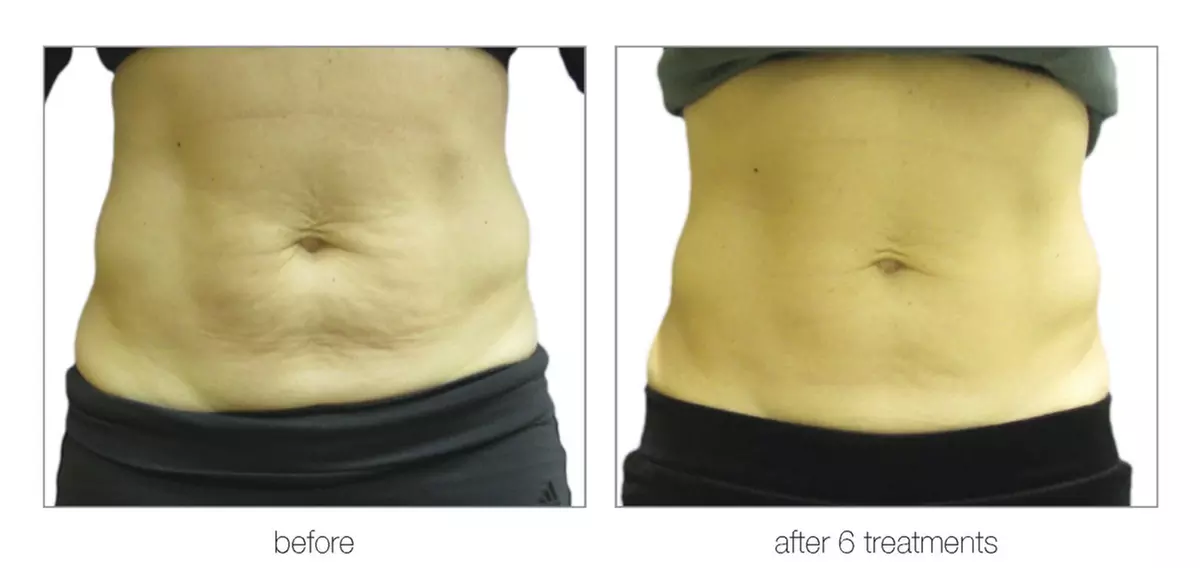 Up to 54% Off on Radio Frequency Skin Tightening at Beauty Factory Boutique Spa