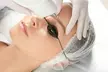 One or Two Sessions: Eyebrow Tattoo PicoLaser Removal at 24K Starlight Aesthetics (Up to 55% Off) - Second Medium
