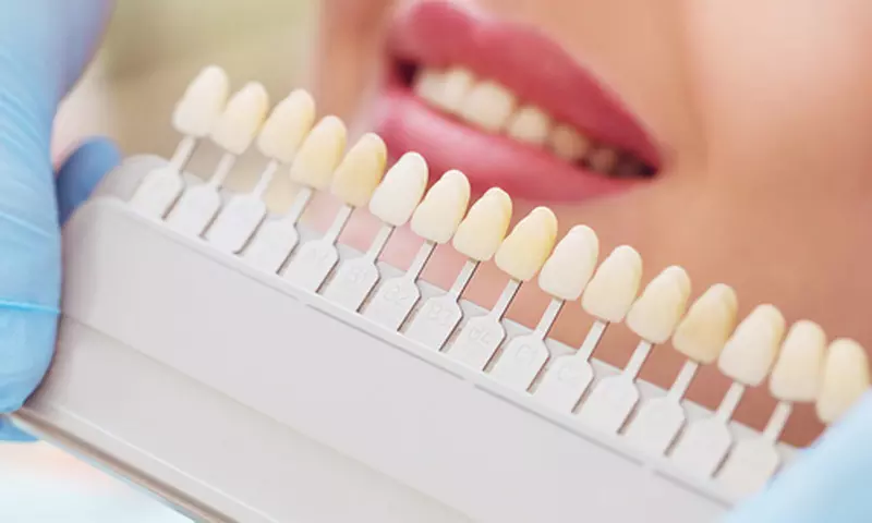 Do 45% zniżki na Wybielanie zębów - tradycyjne w Whitening Point TOR