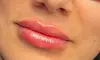 Get 1ML or 2ML Hyaluronic Acid Needle-less Lip Enhancements or Injection at Boho beauty and spa (Up to 30% Off)