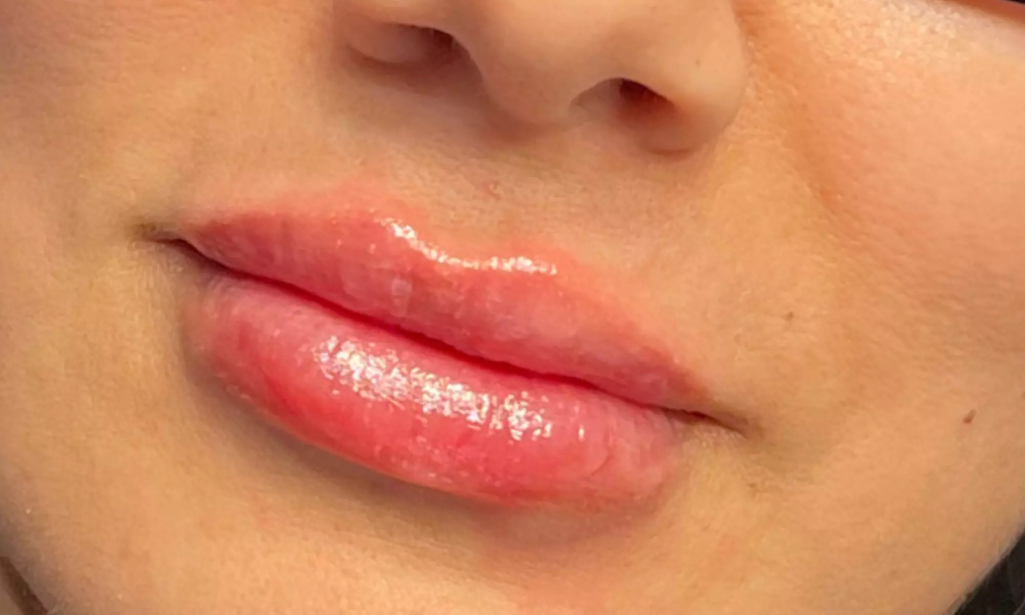 Get 1ML or 2ML Hyaluronic Acid Needle-less Lip Enhancements