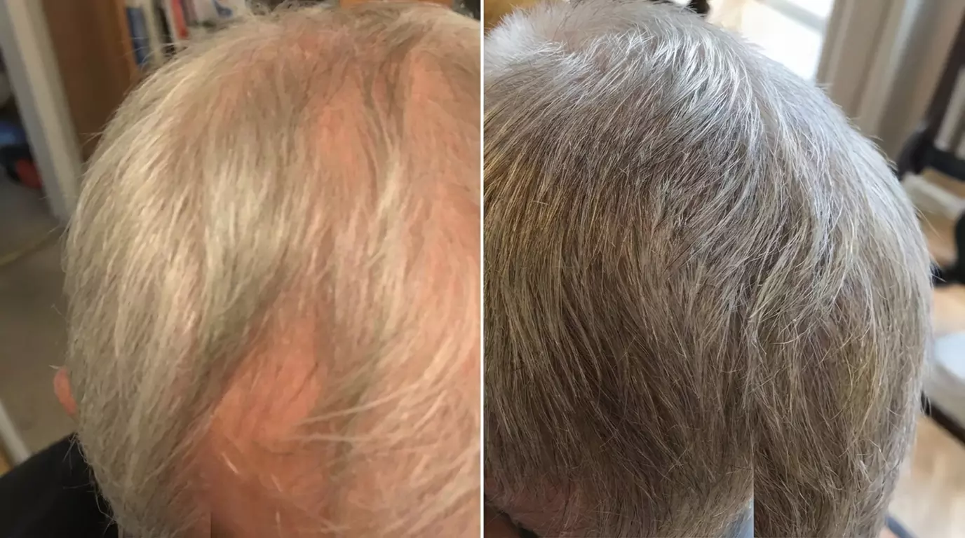 Calecim Hair Restoration Therapy