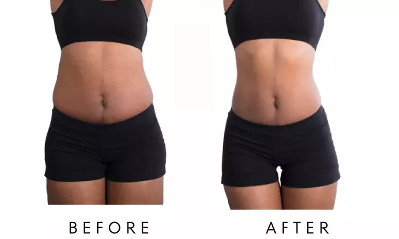 Precision Slim Laser Fat Loss & Skin Tightening, Your Sculpt Studio DC