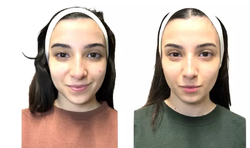 Non Surgical Face Lift with Optional Advanced Skin Tightening