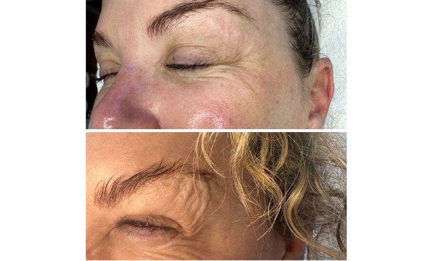 Image 12: CO2 Skin Rejuvenation for Face, Neck, & Eyes