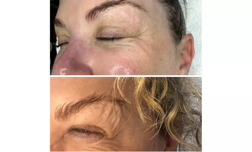Image 12: CO2 Skin Rejuvenation for Face, Neck, & Eyes