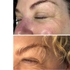 Image 12: CO2 Skin Rejuvenation for Face, Neck, & Eyes