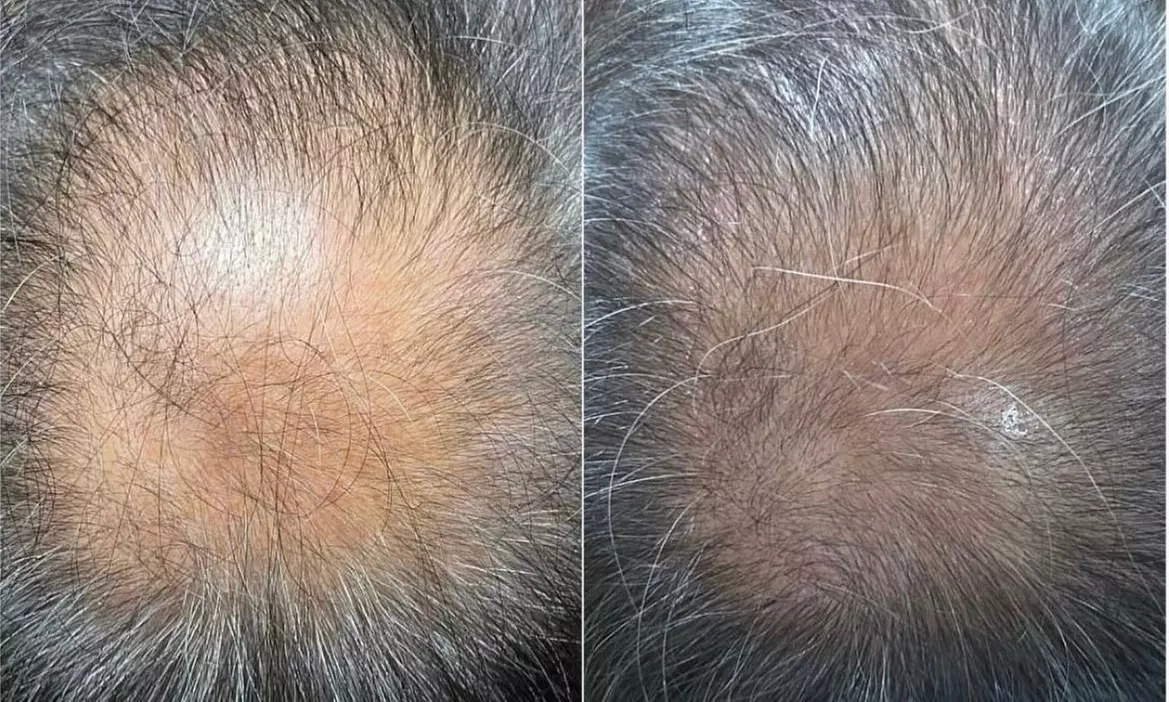 Permanent Makeup & Advanced Microchanneling