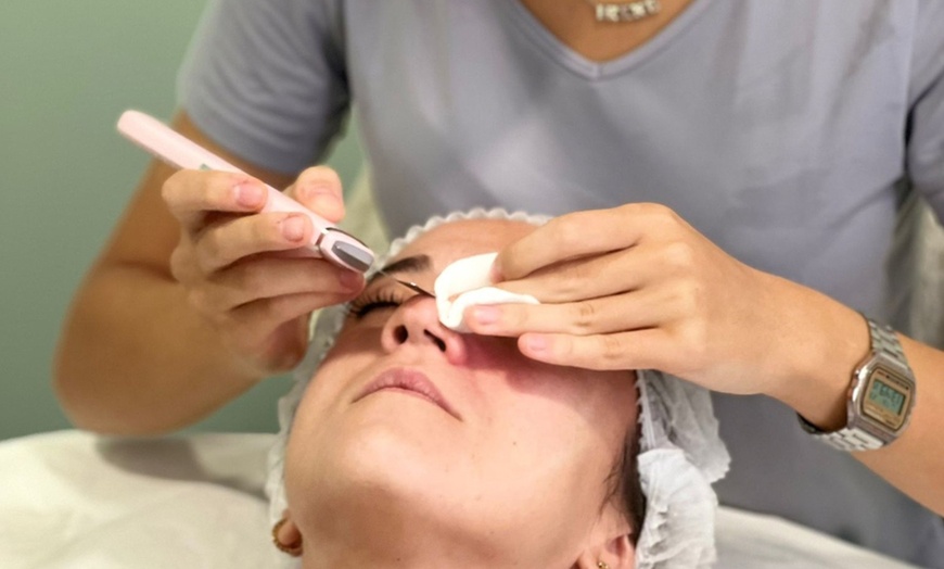 Image 1: 1 o 2 sesiones de exosomas con dermapen en 2 fases en rostro completo 