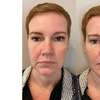 Image 6: Up to 64% Off on Facelift - Thread Lift at DermAlign Medical Aesthetics