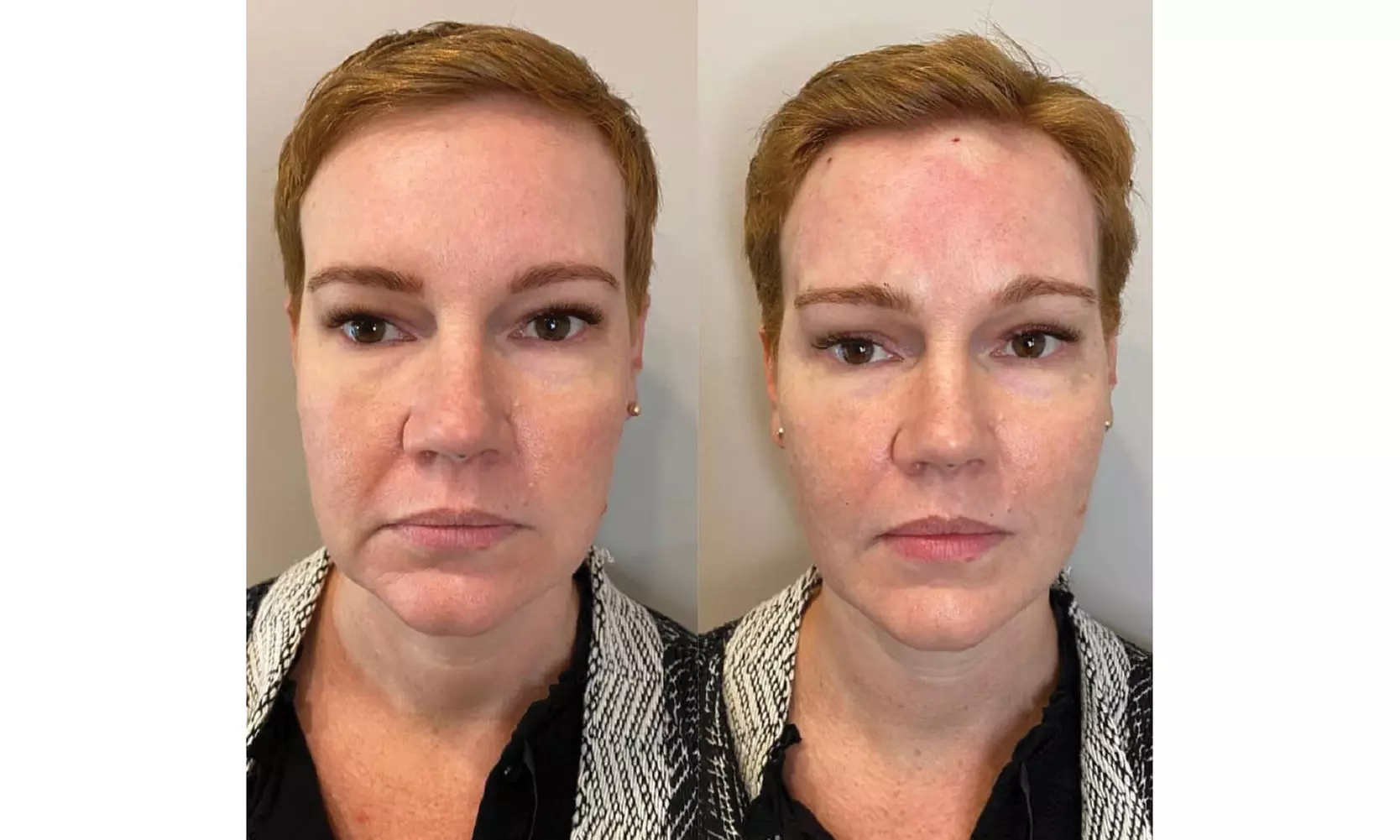 Experience Face PDO Thread Lift and Get a Rejuvenated Look!