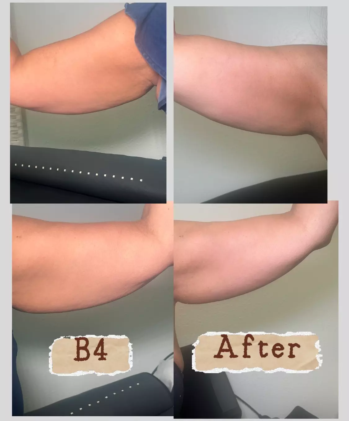 Up to 94% off on Laser Lipo and Ultrasonic Cavitation Treatments