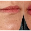 Image 4: Enhance Your Look with 0.5ml, 1ml or 2ml Dermal Filler