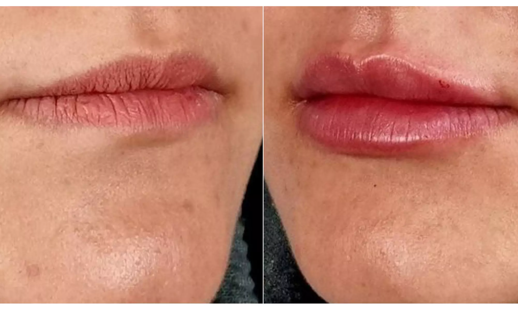 Enhance Your Look with 0.5ml, 1ml or 2ml Dermal Filler