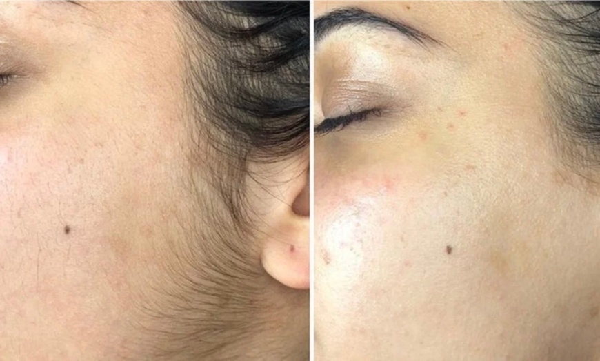 Image 4: Choice of Facial- Classic, Microdermabrasion, or More 