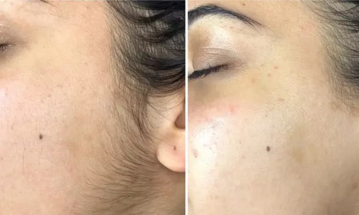 Choice of Facial- Classic, Microdermabrasion, or More 
