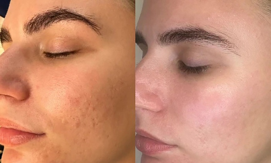 Image 3: Revitalize Your Skin with 1 or 3 Polynucleotide Sessions & Salmon DNA