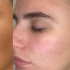 Image 3: Revitalize Your Skin with 1 or 3 Polynucleotide Sessions & Salmon DNA