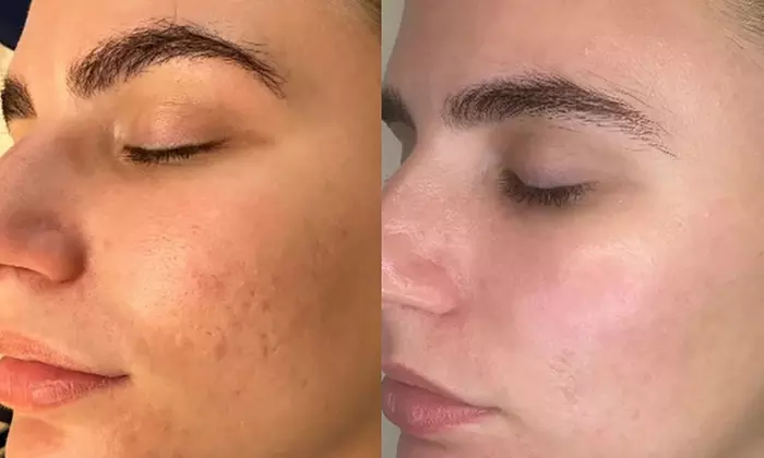 Revitalize Your Skin with 1 or 3 Polynucleotide Sessions & Salmon DNA