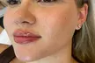 0.5ml or 1.1ml EPTQ Lip Filler for Natural-Looking Volume & Definition at Eliora Aesthetics(Up To 55% Off) - Image 3