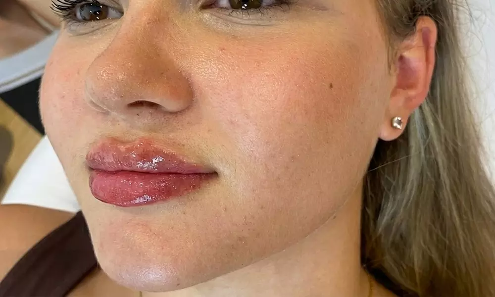 EPTQ Lip Filler 0.5ml or 1.1ml for Fuller, Defined Lips