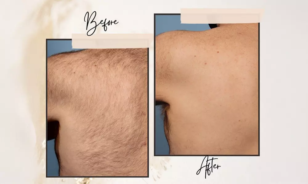 Laser Hair Removal: Brazilian, Underarms, Half Legs & Area Packs