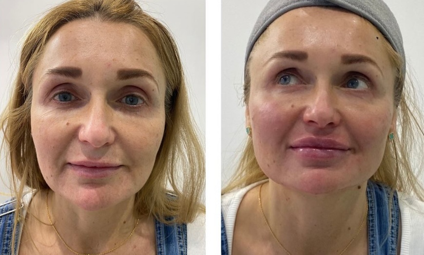 Image 8: Up to 45% Off on Injection Dermal Filler - Eleganza Aesthetics