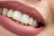 30 or 60-Minute Teeth Whitening Or Family Plan - 60-Minute Teeth Whitening Session for 2 People (Up to 70% Off) - Second Medium