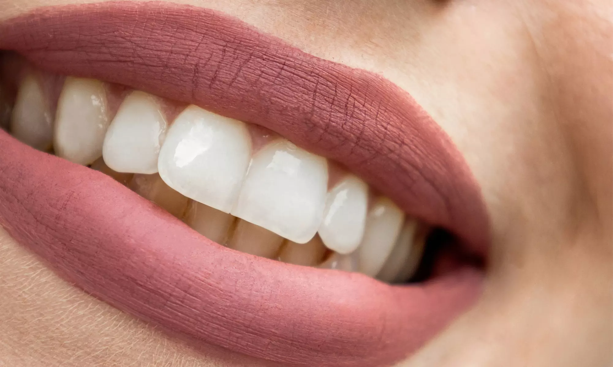 30 or 60-Minute Teeth Whitening Or 60-Minute Teeth Whitening for Two
