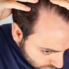 Image 2:  66% Off PRP Injections for Full Face or Hair Restoration