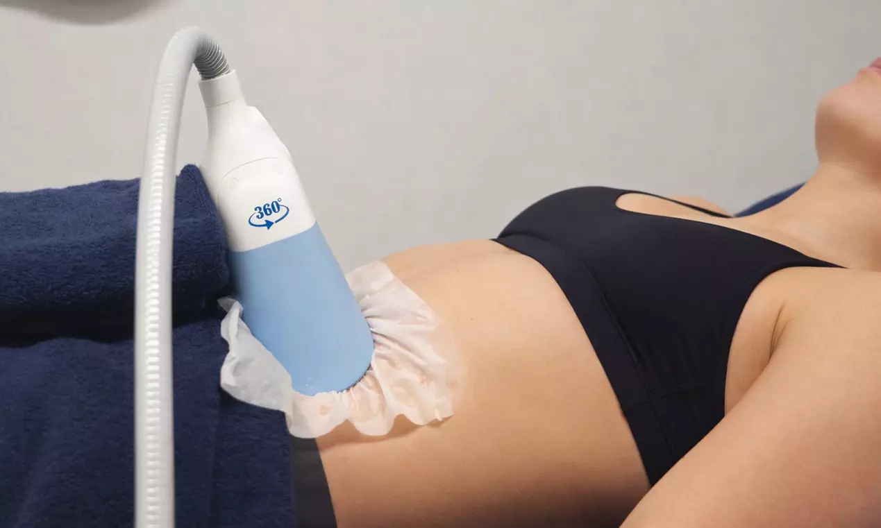 1, 2 oder 3 Kryolipolyse-Behandlungen an einer Zone für 1 Person