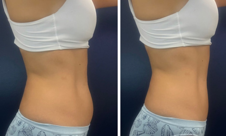 Image 7: Transform with EMS, TruFlex, Cavitation, Vacuum or Infrared Therapy