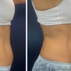 Image 7: Transform with EMS, TruFlex, Cavitation, Vacuum or Infrared Therapy