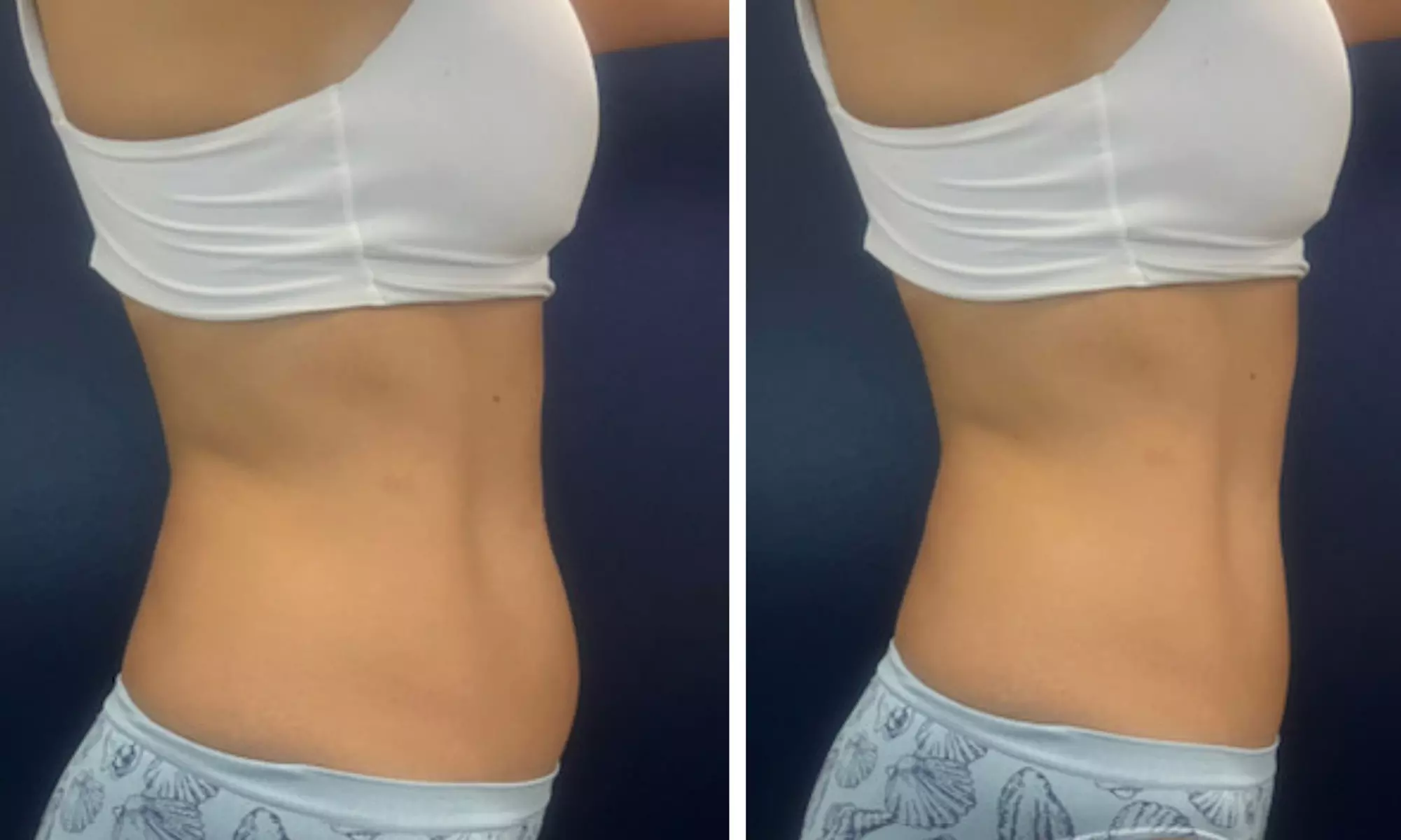 Transform with EMS, TruFlex, Cavitation, Vacuum or Infrared Therapy
