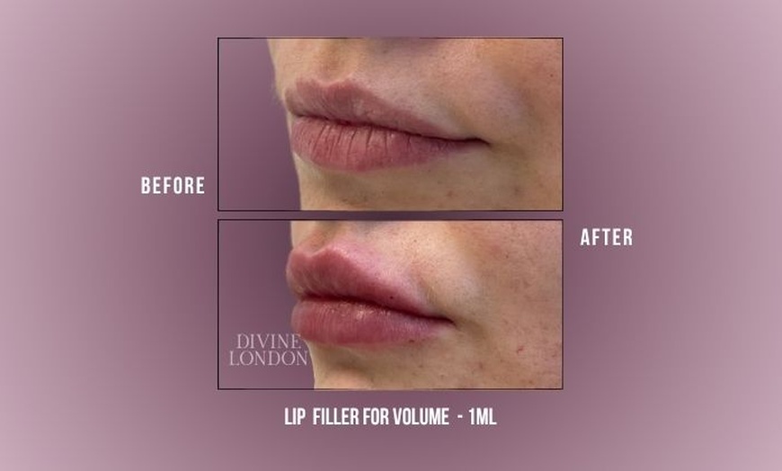 Image 2: Up to 71% Off on Injection - Dermal Filler at Divine Aesthetics Clinic London