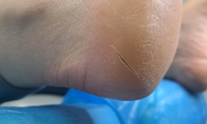 Image 4: Konsultacja podologiczna z zabiegiem lub badaniem