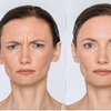 Image 1: 20, 40, or 60 Units of Botox for Fine Lines & Full-Face Refresh