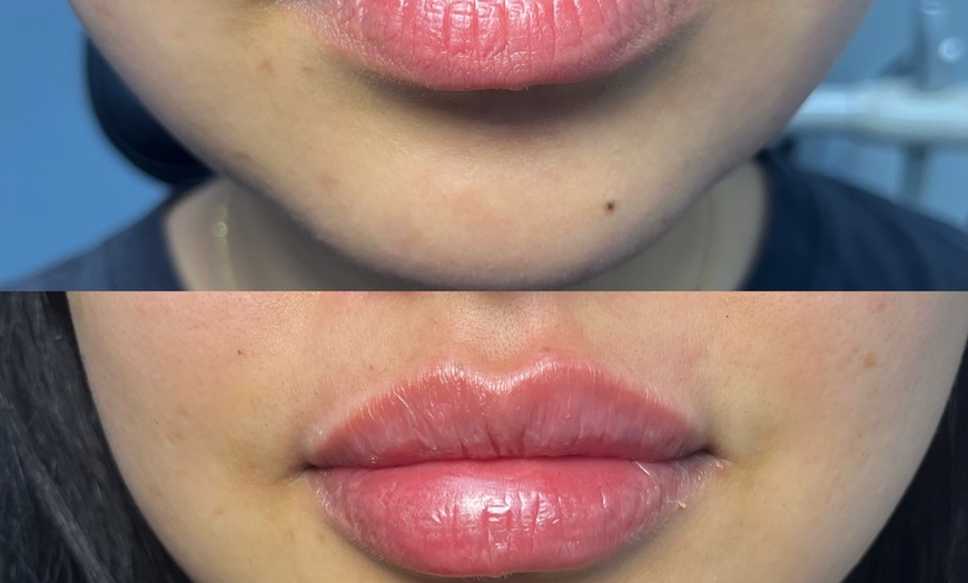 Image 3: Refresh Your Skin with 20, 40, or 60 Units of Neurotoxin