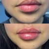 Image 3: Refresh Your Skin with 20, 40, or 60 Units of Neurotoxin