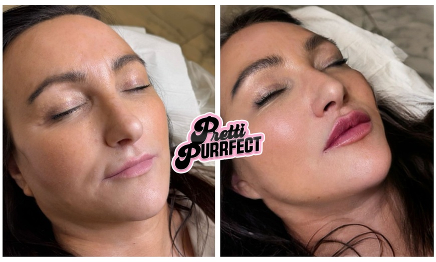 Image 2: One or Two Profhilo® Skin Revitalising Booster Sessions