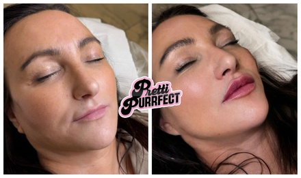 0.5ml Dermal Filler - Lips (Russian or Classic) - Pretti Purrfect