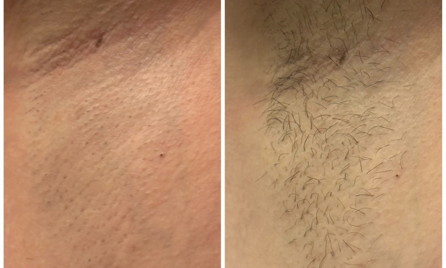 Image 3: Get One Year of Unlimited Laser Hair-Removal Sessions
