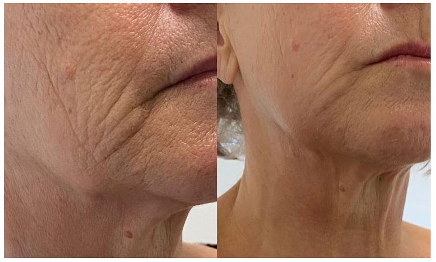 Image 3: Rejuvenate with One HIFU Treatment For Full Face, Neck or Both 