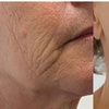Image 3: Rejuvenate with One HIFU Treatment For Full Face, Neck or Both 
